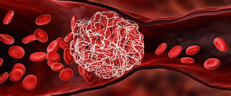 What to Know About Blood Clots and COVID-19