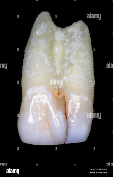 tooth fusion or gemination or concrescence Stock Photo - Alamy