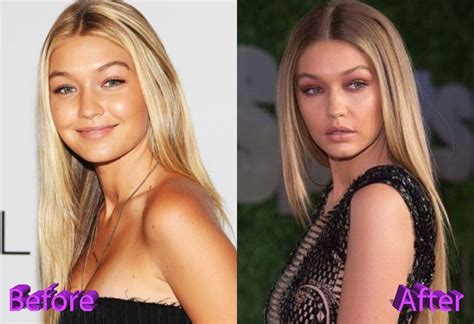 Gigi Hadid Before and After Plastic Surgery | Gigi hadid plastic surgery, Gigi hadid before ...