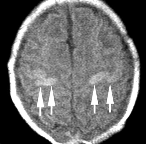 Hypoxic-Ischemic Brain Injury: Imaging Findings from Birth to Adulthood | RadioGraphics