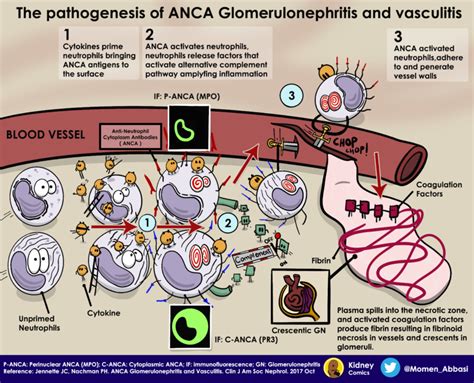 Kidney Comics: The Pathogenesis of ANCA Associated Vasculitis - Renal ...