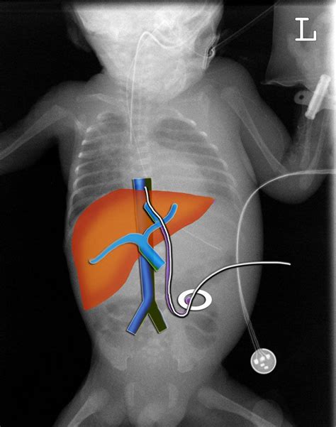 umbilical recess catheter - Google Search | Neonatal, Neonatal nurse, Chest tube