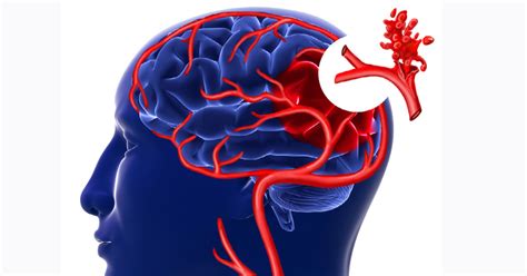brain aneurysm symptoms Neurosurgeon warns: don't ignore the signs of an aneurysm | hothub