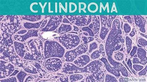 Cylindroma Histology