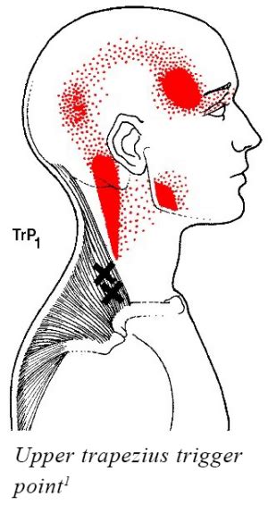 Head and Neck Pain? Learn How to Manage Your Trigger Points - Pickering Village Chiropractic ...