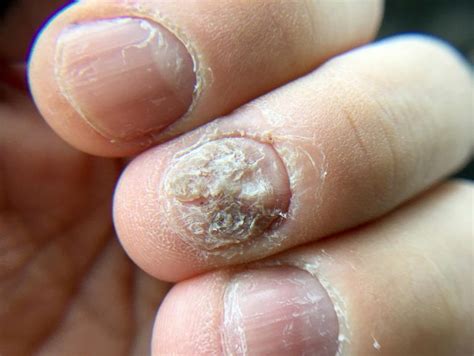 REMEDIES TO GET RID OF NAIL FUNGUS - Health GadgetsNG