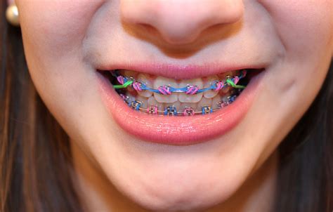 How To Look Your Best With Braces | Diva Likes