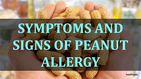 SYMPTOMS AND SIGNS OF PEANUT ALLERGY - YouTube