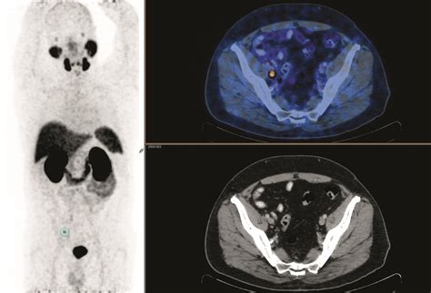 PET Scan Identifies Which Prostate Cancer Patients Can Benefit from ...