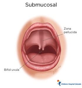 Cleft Lip & Palate | Children's Hospital Colorado