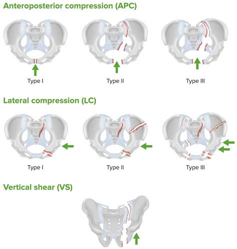 Pelvic Fractures | Concise Medical Knowledge