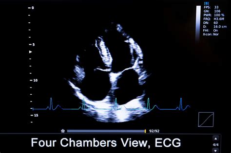 Get Your Best APICAL 4 Chamber View with POCUS - Point-of-Care ...