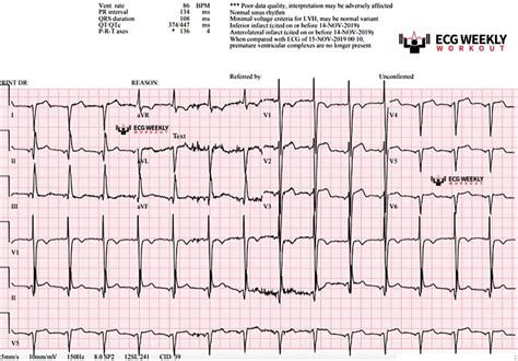 Weekly Case – ECG Weekly