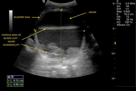 Bladder Scanning in Hematuria ~ Ultrasound Cases Info