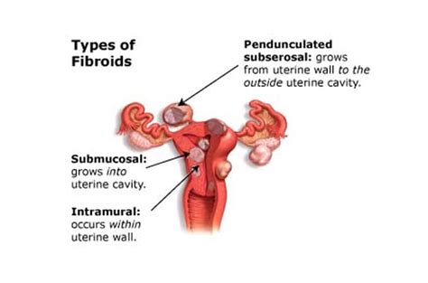 Fibroids During Pregnancy - Health & Parenting