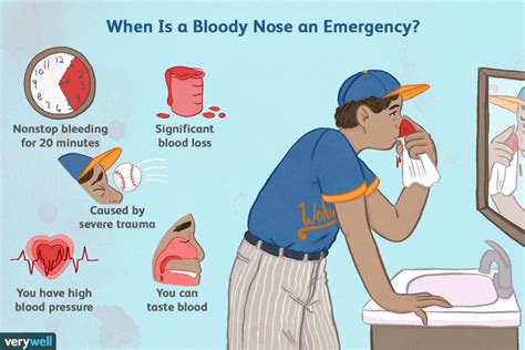 HOW TO STOP NOSEBLEED AT HOME | HealthGist.Net