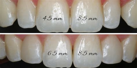 denture teeth size chart - Torku