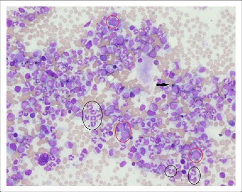 The peripheral blood smear reveals marked leukocytosis with predominant ...