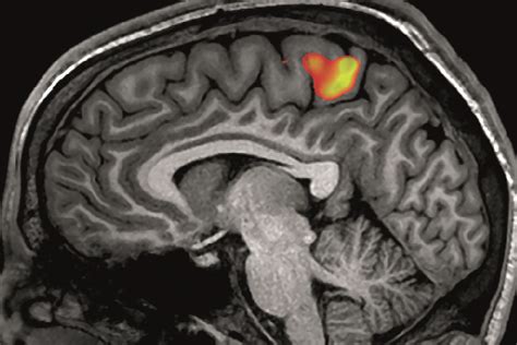 Brain scans predict placebo responses in chronic pain patients - The ...