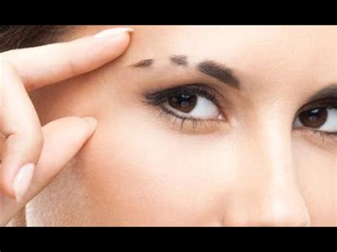 Can Anything Be Done For Alopecia Areata Of The Eyebrows? - YouTube