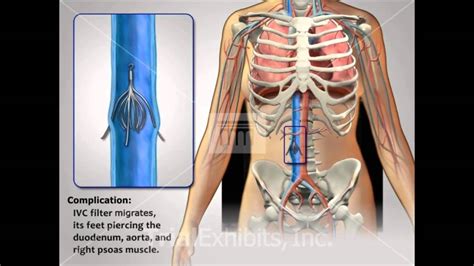 IVC Filter Complications - Medical Animation - YouTube