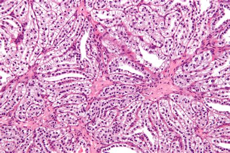 File:Clear cell papillary renal cell carcinoma - high mag.jpg