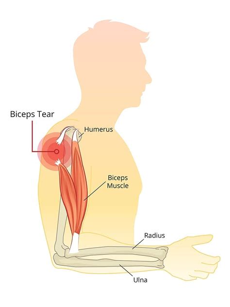 Dr Terence Moopanar | Biceps tenodesis