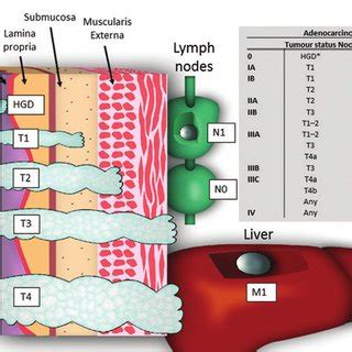 Esophageal cancer staging: The TNM (tumor, node, and metastasis ...