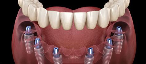 All-on-6 Dental Implants - Procedure | Benefits | Need | Cost - Implants Pro Center