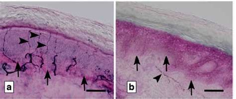 Diagnosing Fibromyalgia The Small Nerve Fiber Way - Health Rising