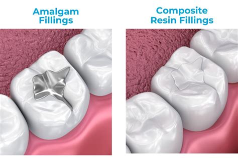 Choosing the Right Dental Fillings: Composite vs. Amalgam