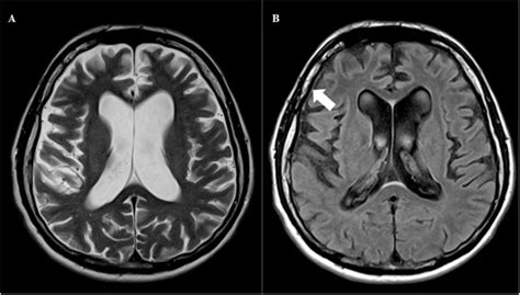 Neurosyphilis: The shape of a rising threat - International Journal of Infectious Diseases