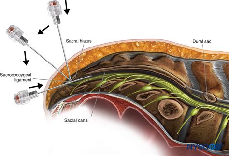 Caudal Anesthesia - NYSORA