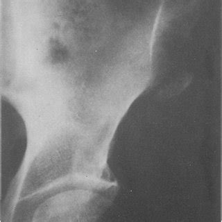 Radiograph of right hip showing an avulsion fracture of the anterior... | Download High ...