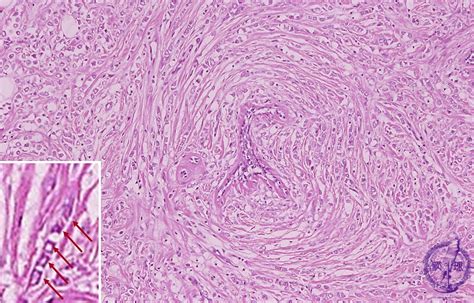 14.Breast (7) Invasive lobular carcinoma|Pathology Core Pictures