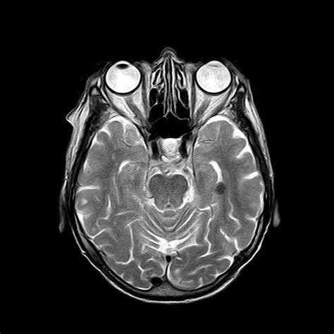 New MRI technique can detect early dysfunction of the blood-brain barrier with small vessel disease