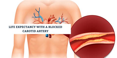 Life Expectancy and Prognosis for Individuals with Blocked Carotid Artery