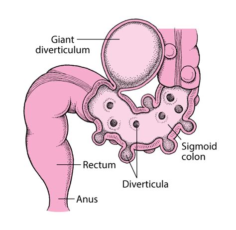 Diverticulosis of the Large Intestine - Digestive Disorders - MSD Manual Consumer Version