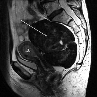 MRI of Endometrial Carcinoma | Radiology Key