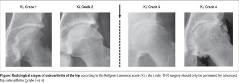 Total Hip Replacement for Osteoarthritis (29.10.2021)