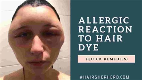 Allergic Reaction To Hair Dye On Scalp Archives - Hairshepherd