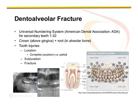 Imaging of Facial Trauma