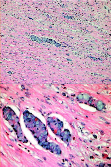 Upper panel: goblet cell carcinoid characterised by nests of goblet ...