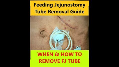 Feeding Jejunostomy Tube – How & When to Remove . All You Need to Know About FJ Tube. - YouTube