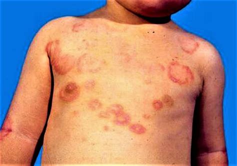 Rheumatic fever causes, signs, symptoms, complications & treatment