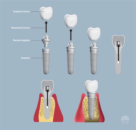 All On 4 Dental Implants - Portland Perio Implant Center