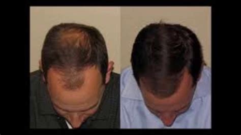 How Fast Will Your Hair Grow Using Castor Oil Before And After - YouTube