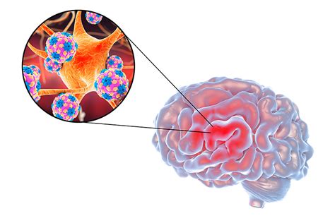 encephalitis virus