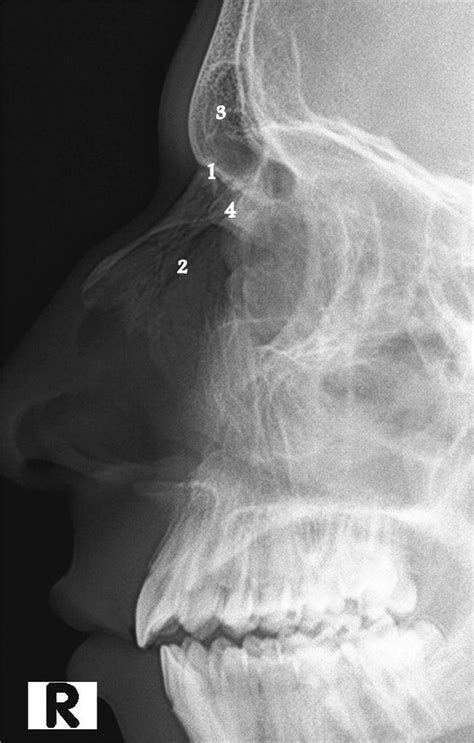 Nasal bones - x-ray | Radiology Case | Radiopaedia.org Radiology Schools, School Scores, Nose ...