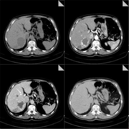 Hepatic Hemangioma Mri